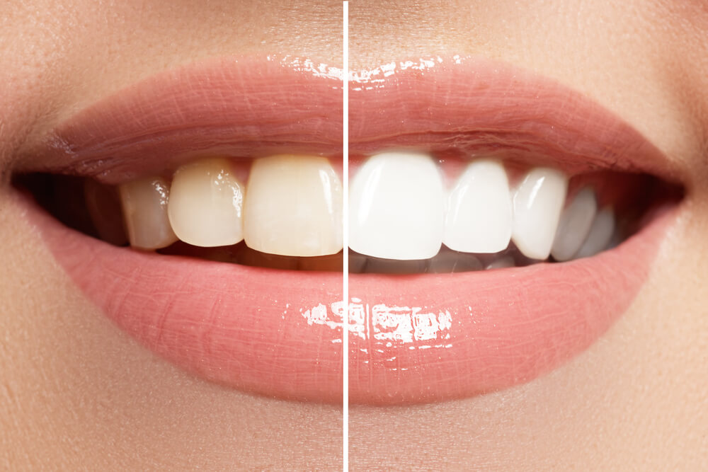 porównanie koloru zębów