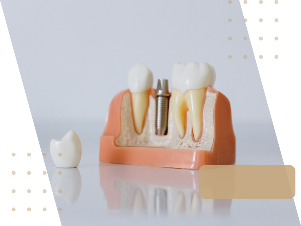 Implanty dentystyczne. Klinika Akademii Stomatologii w Łodzi