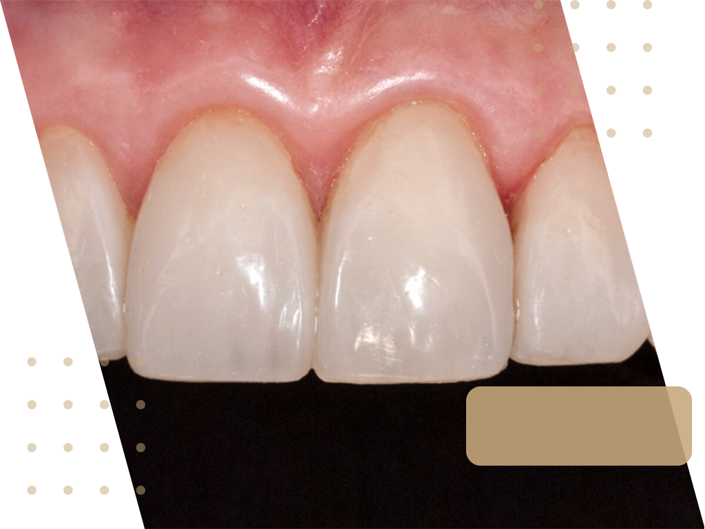 Bonding zębów. Klinika Akademii Stomatologii w Łodzi.