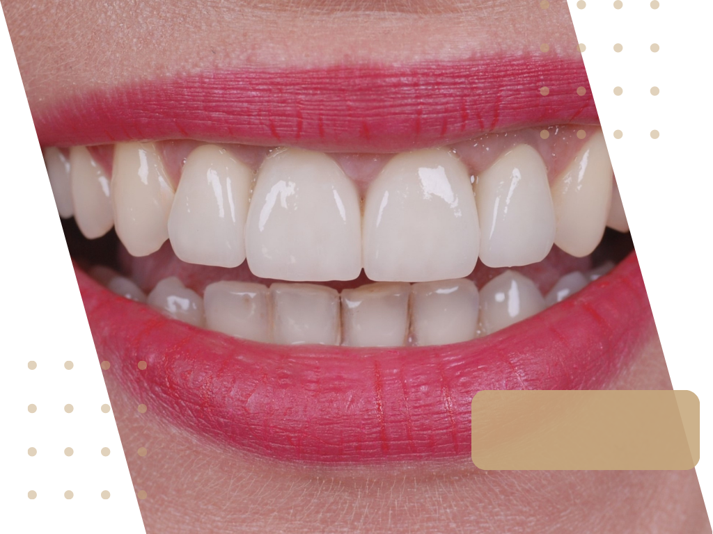 Licówki - Protetyka stomatologiczna. Klinika Akademii Stomatologii w Łodzi