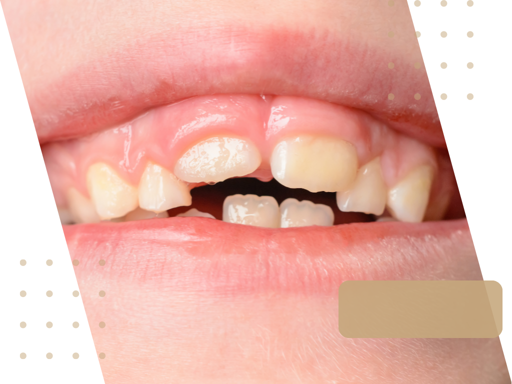 Nakładki prostujące zęby. Klinika Akademii Stomatologii w Łodzi.