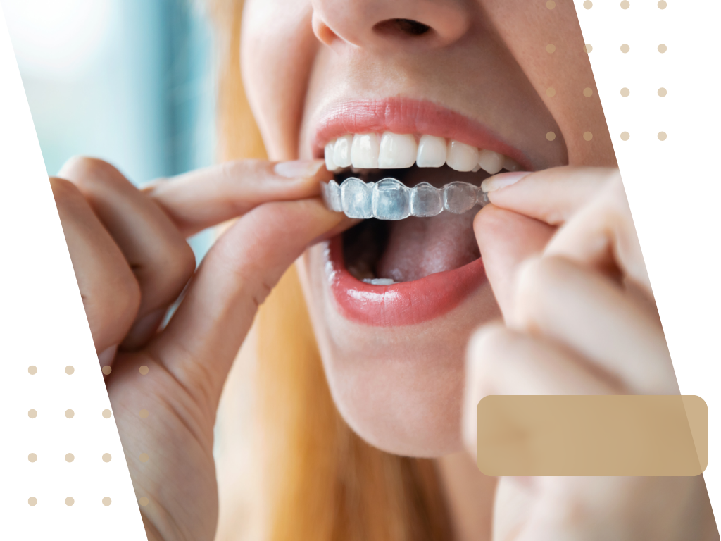 Nakładki prostujące zęby. Klinika Akademii Stomatologii w Łodzi.
